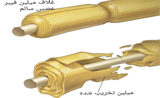 زنگ خطر سندروم گیلن&zwnj;باره با احساس مور مور شدن به صدا در می&zwnj;آید