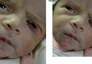 پرونده قصور پزشکی در حادثه پارگی پلک نوزاد نطنزی به کجا رسید؟