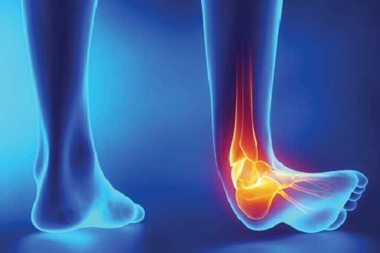 پس از پیچ خوردن مچ&zwnj;پا چه باید کرد؟