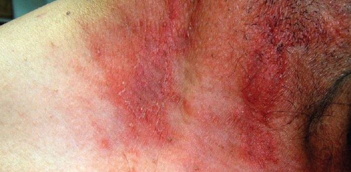 حشره&zwnj;ای موذی که بلای وحشتناکی بر سر پوستتان می&zwnj;آورد + تصاویر