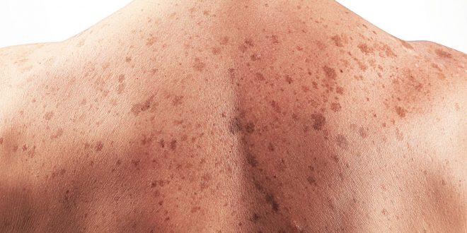 ساعت۲۰/ دلایل افزایش لکه های قهوه ای بر پوست چیست ؟