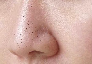 جوش&zwnj;های سرسیاه را با موثرترین راهکار&zwnj;ها محو کنید