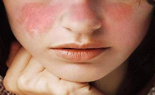 مبتلایان به لوپوس چه موقع می&zwnj;توانند باردار شوند؟