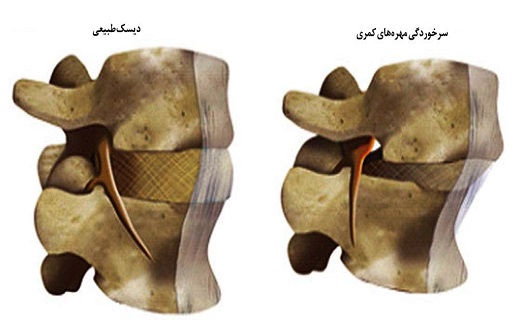 آسیب ستون فقرات کمری که بیشتر به سراغ زنان می&zwnj;آید