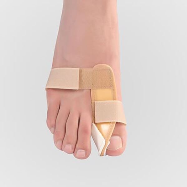 چگونه انحراف انگشت شست پا را درمان کنیم؟