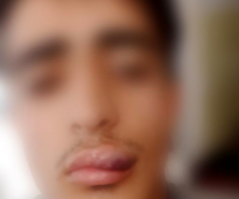 جراحت شدید دانش آموز زنجانی بر اثر ضرب و شتم معلم ورزش!+ عکس