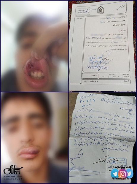 جراحت شدید دانش آموز زنجانی بر اثر ضرب و شتم معلم ورزش!+ عکس