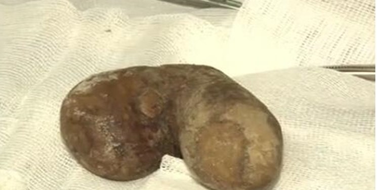 داروی جدید برای دفع راحت سنگ کلیه