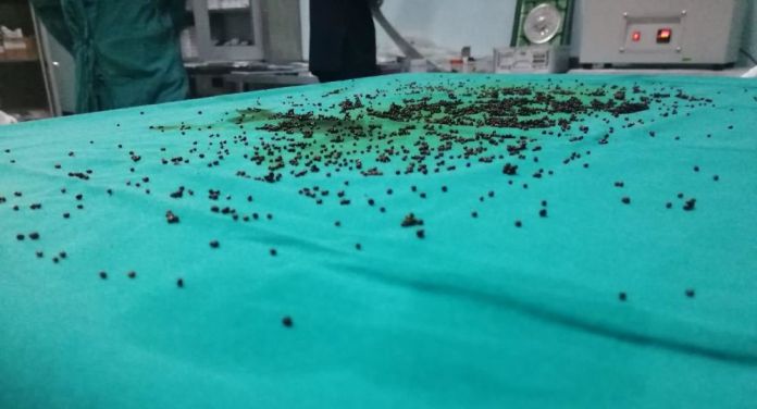 اتفاقی عجیب در دنیای پزشکی/ خروج ۳۷۶۵ سنگ از کیسه صفرای یک زن در ترکیه+عکس