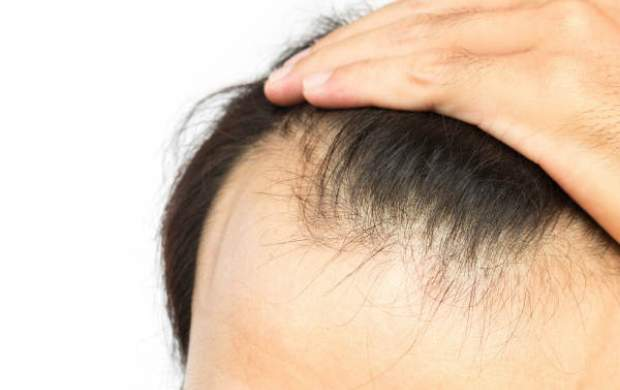 همه&zwnj;چیز درباره انواع ریزش موی سر + راهکار&zwnj;های درمان