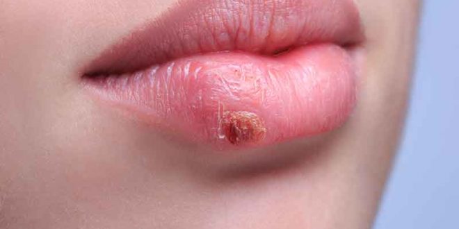 چطور مانع انتشار تبخال شویم؟