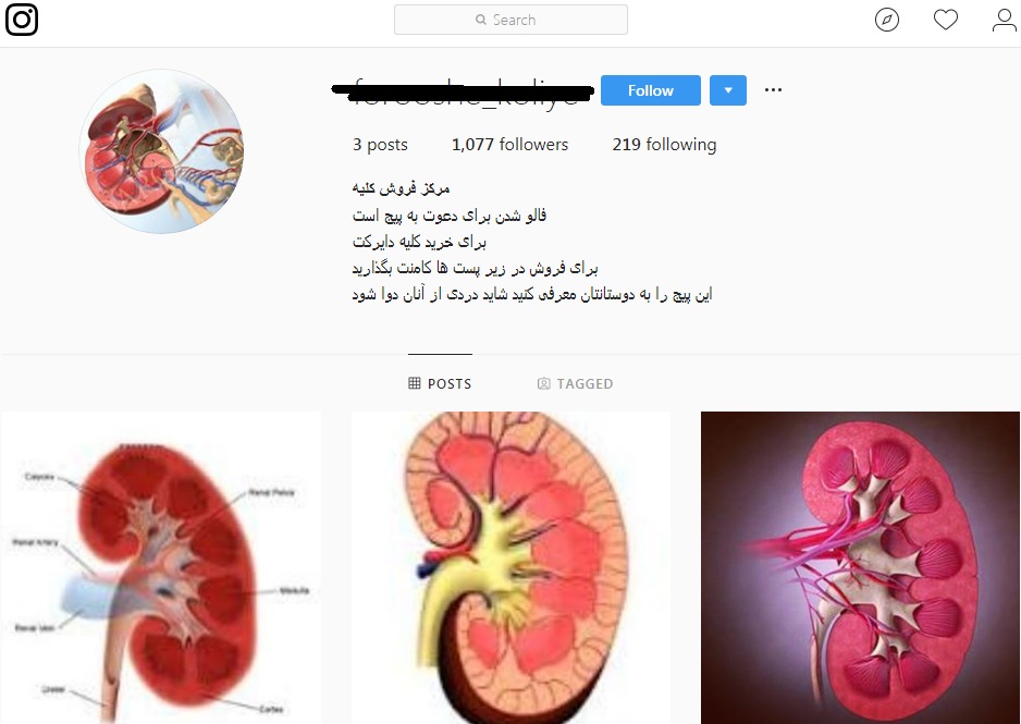 خداحافظی با «کلیه فروشی»/ بساط خرید و فروش اعضای بدن جمع می شود؟! خداحافظی با «کلیه فروشی»/ بساط خرید و فروش اعضای بدن جمع می شود؟!