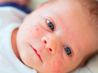 سندرم&zwnj;های عصبی پوستی//صادقی