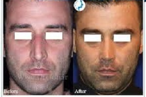 قبل از جراحی بینی مطمئن شوید این مشکل را ندارید