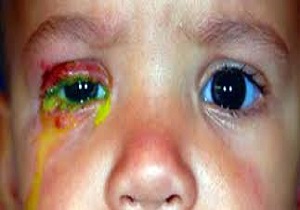 همه چیز درباره مرگبار‌ترین سندرم ژنتیکی دنیا