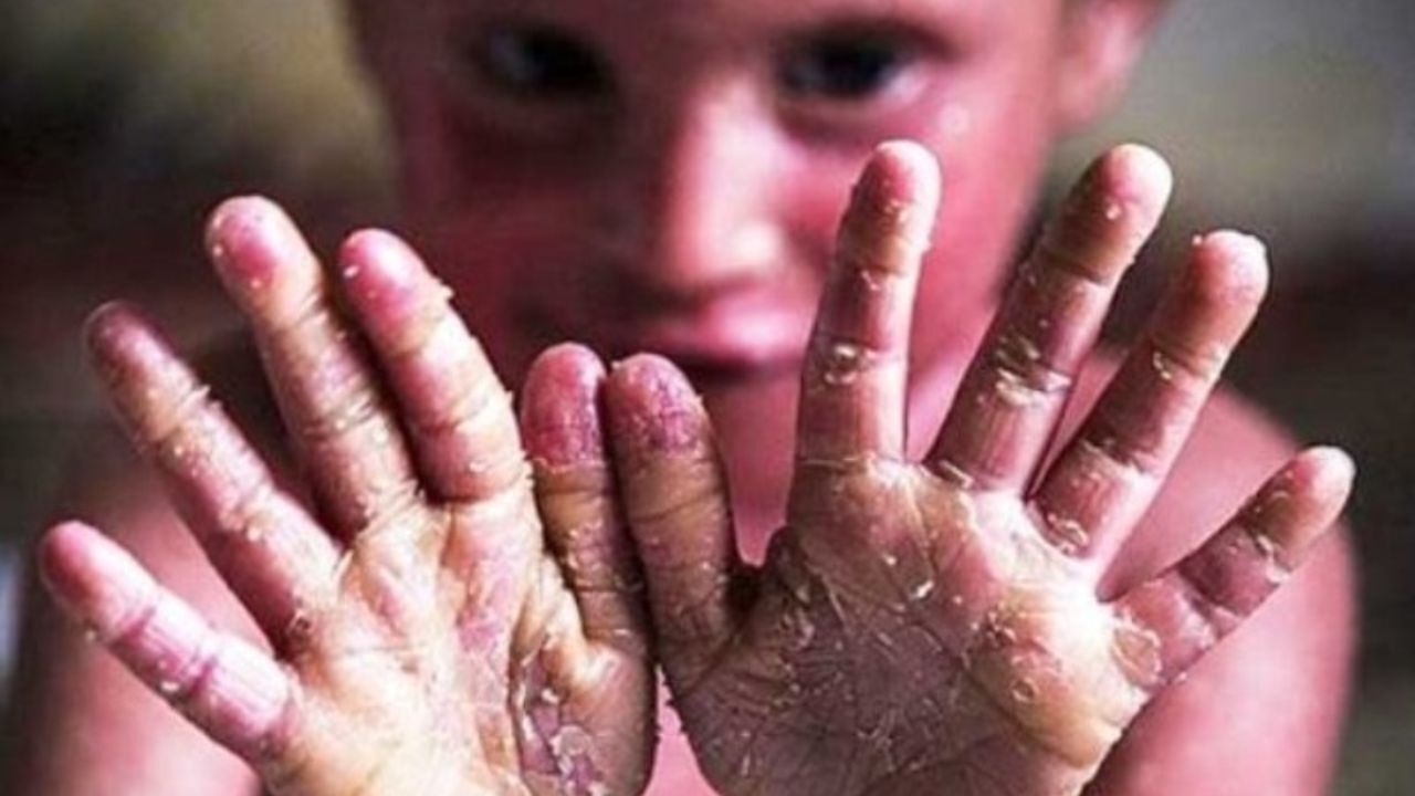وحشتناک ترین بیماری پوستی جهان را بشناسید