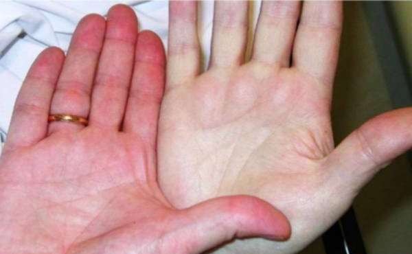 کم خونی را چگونه تشخیص دهیم؟ / چگونه تشخیص دهیم کم خونی داریم ؟