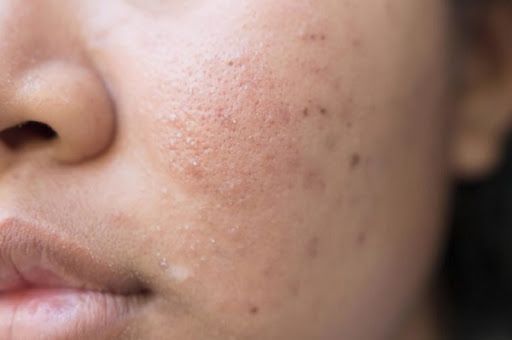 ویروس کرونا؛ مشکلات پوستی از نشانه های کروناست؟