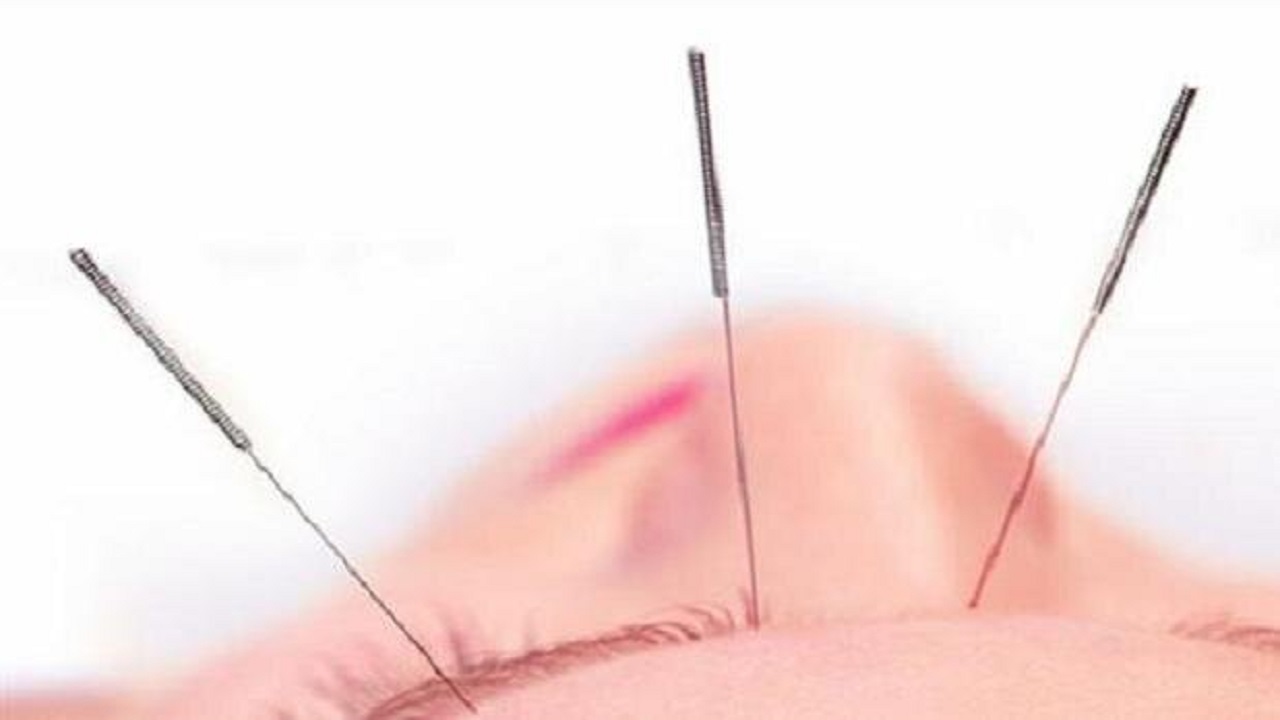 طب سوزنی به پیشگیری از میگرن کمک می‌کند