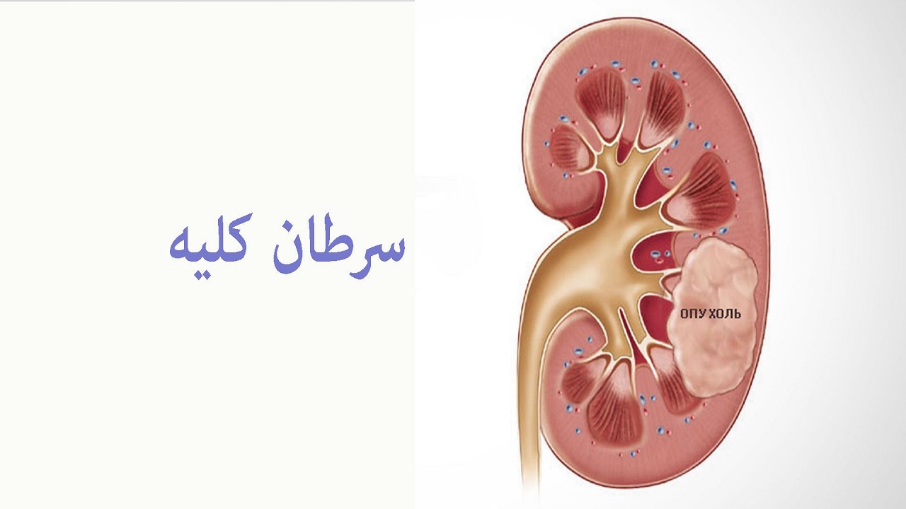 نشانه‌ای هشداردهنده که از سرطان کلیه خبر می‌دهد