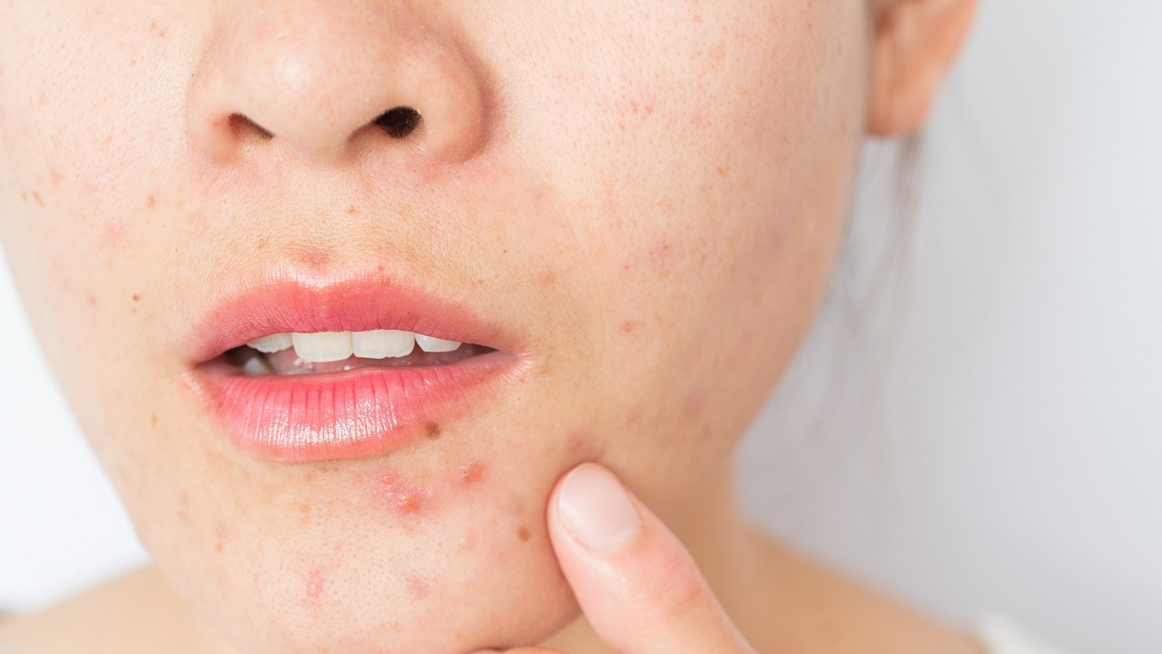 ۷ خوراکی دردسر ساز برای پوست! + پیشگیری از آکنه