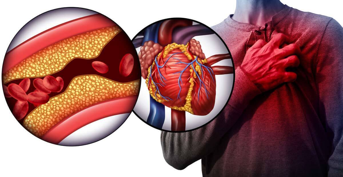 آنژین قلبی
