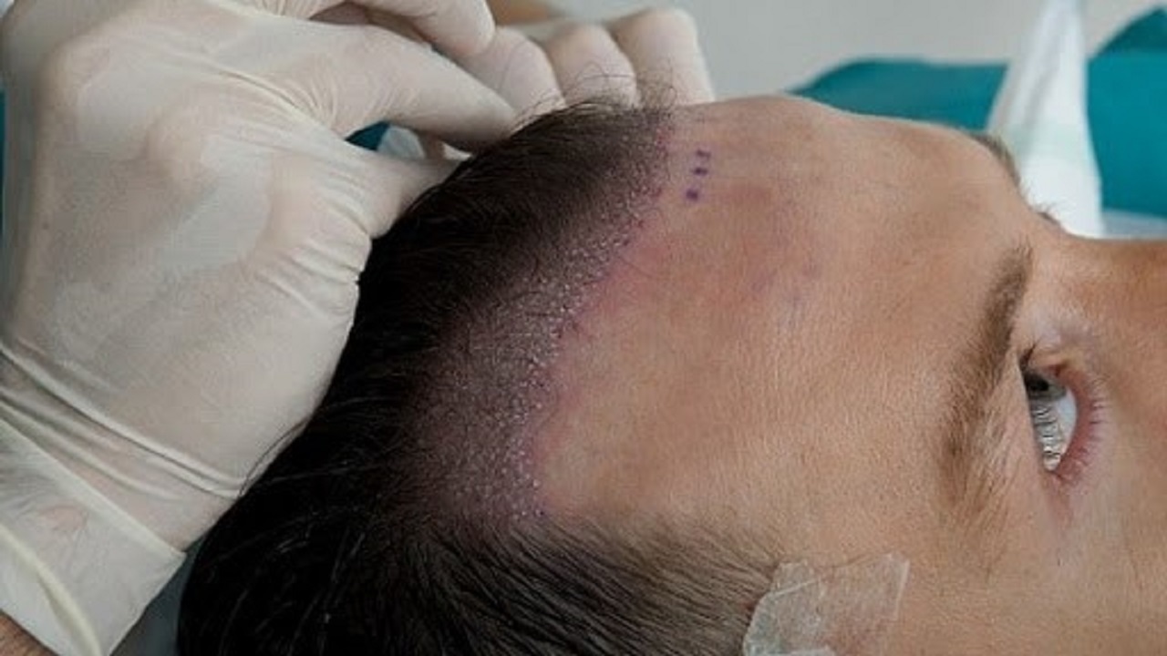 جدیدترین روش های کاشت مو را با کلینیک رویان سلامت بشناسید!