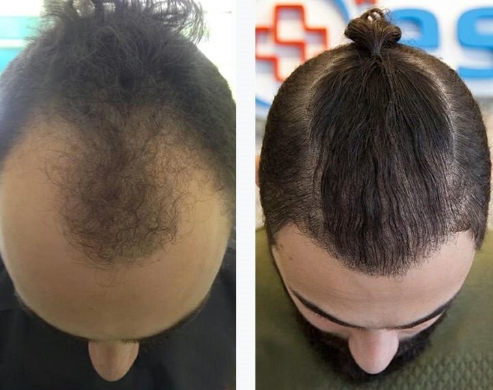 جدیدترین روش های کاشت مو را با کلینیک رویان سلامت بشناسید!