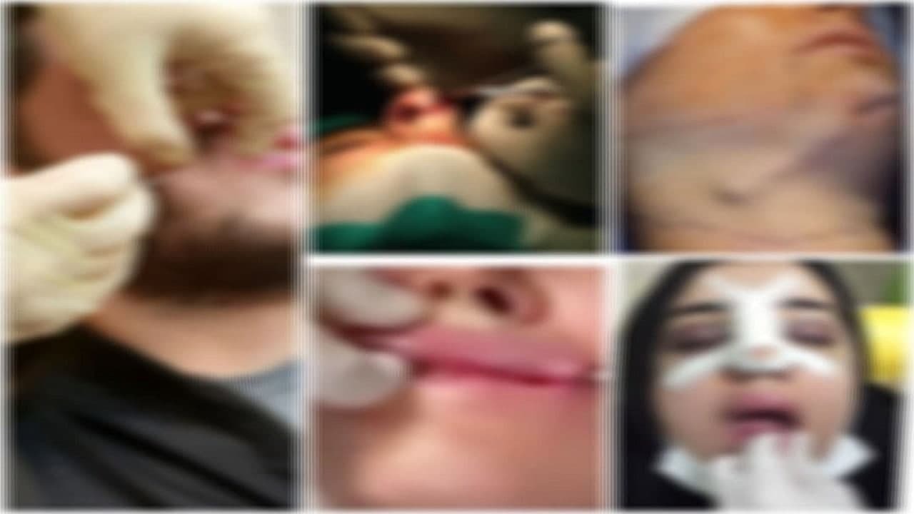 دمیدن بلاگر‌ها در تنور داغ جراحان زیبایی/ چگونه بازار «بکش و خوشگلم کن» در فضای مجازی سکه شد؟ (۱۵+)