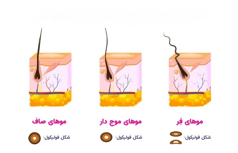 تعیین شکل مو