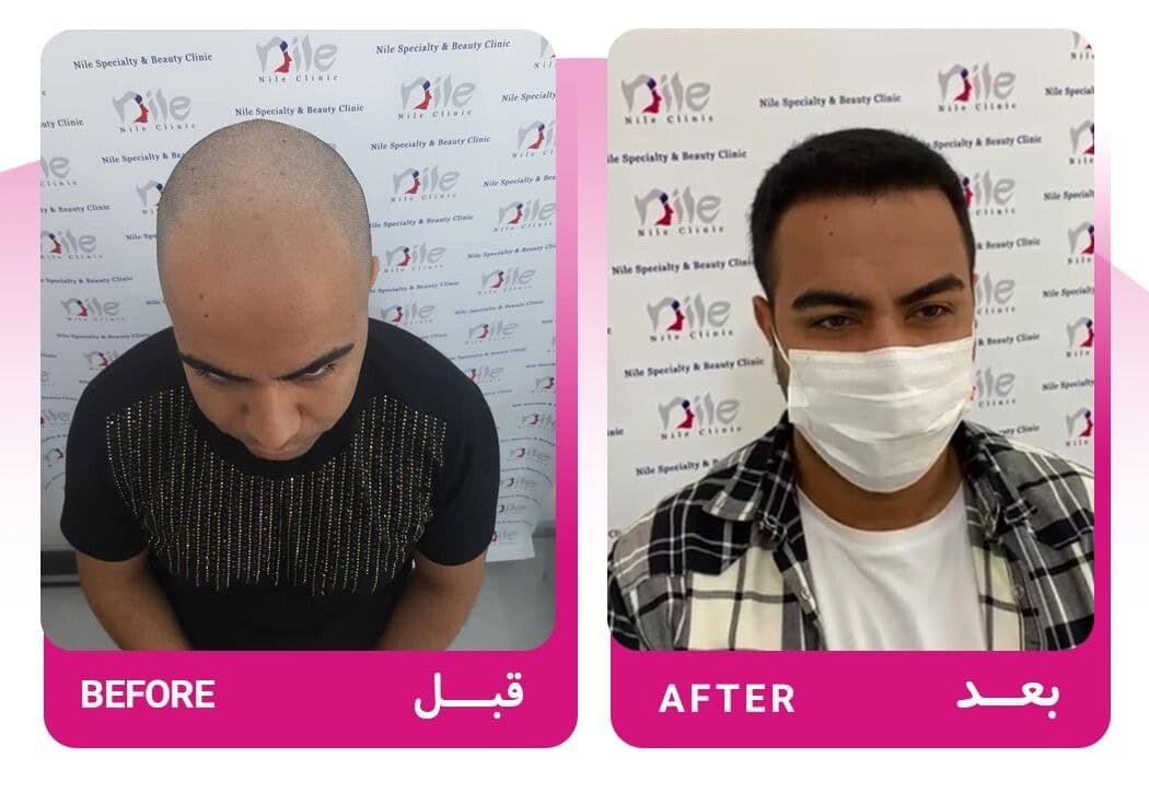 خدمات کاشت مو به روش میکروگرافت در کلینیک نیل شهرک غرب