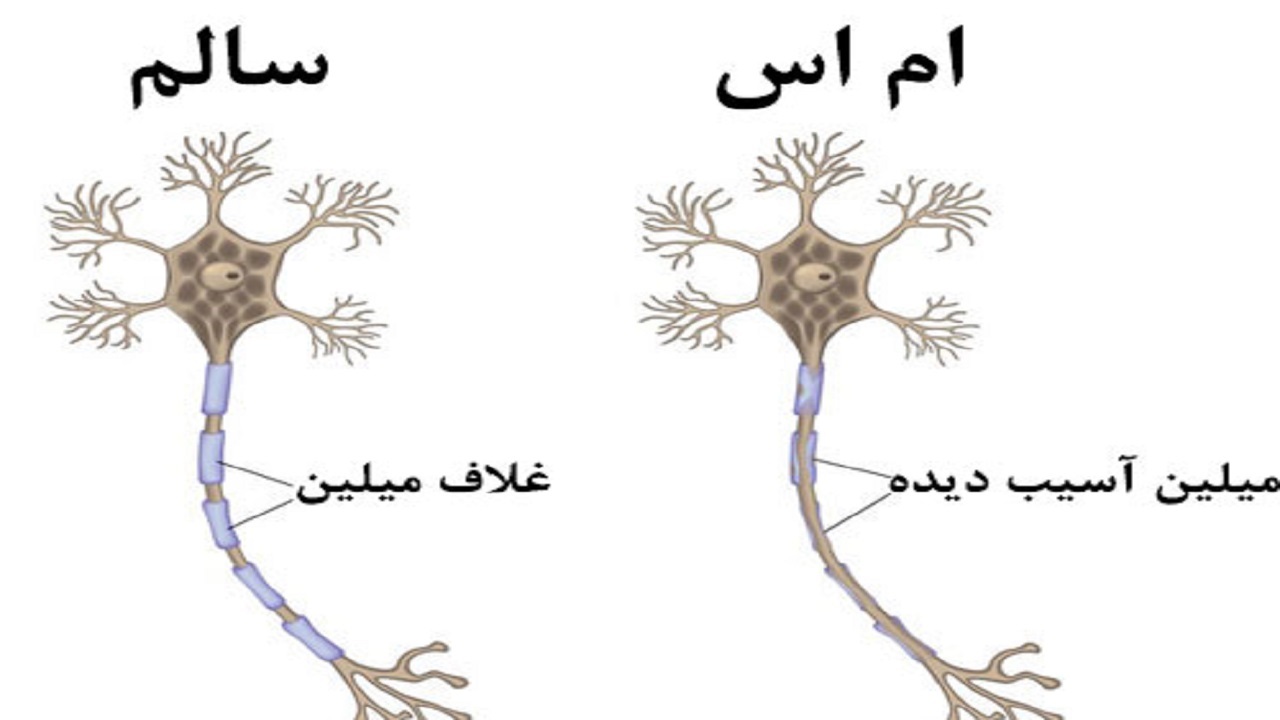 ۲۵۰۰ بیمار ام اس در کرمانشاه وجود دارد