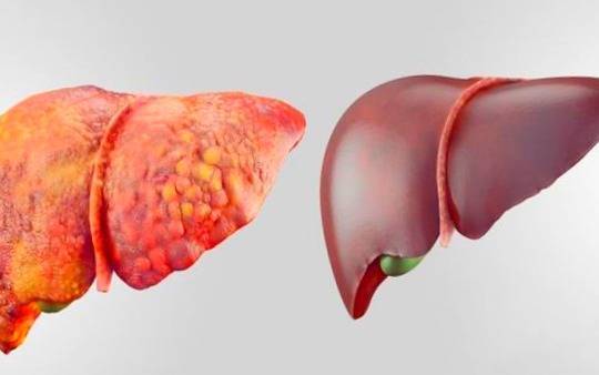 التهاب کبد چرب و خطرناکترین علامت آن