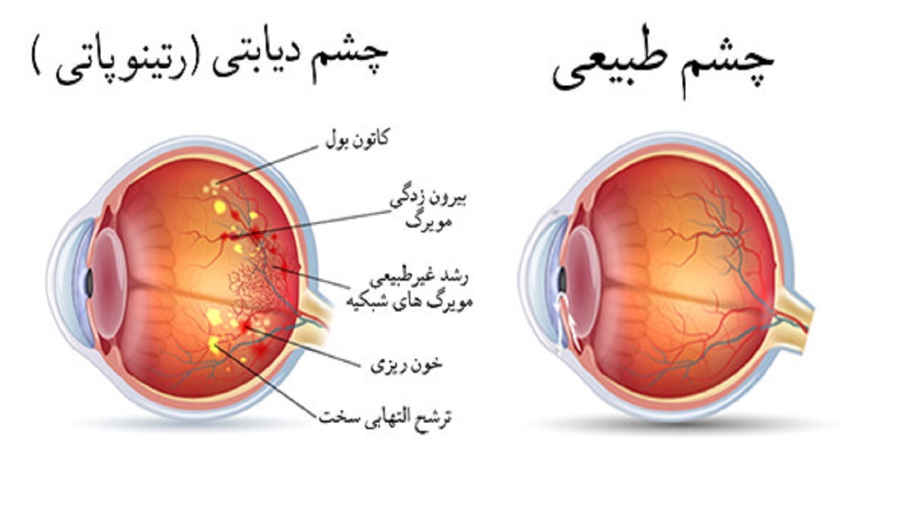 عارضه‌ای که بیشترین تغییرات را در شبکیه چشم ایجاد می‌کند