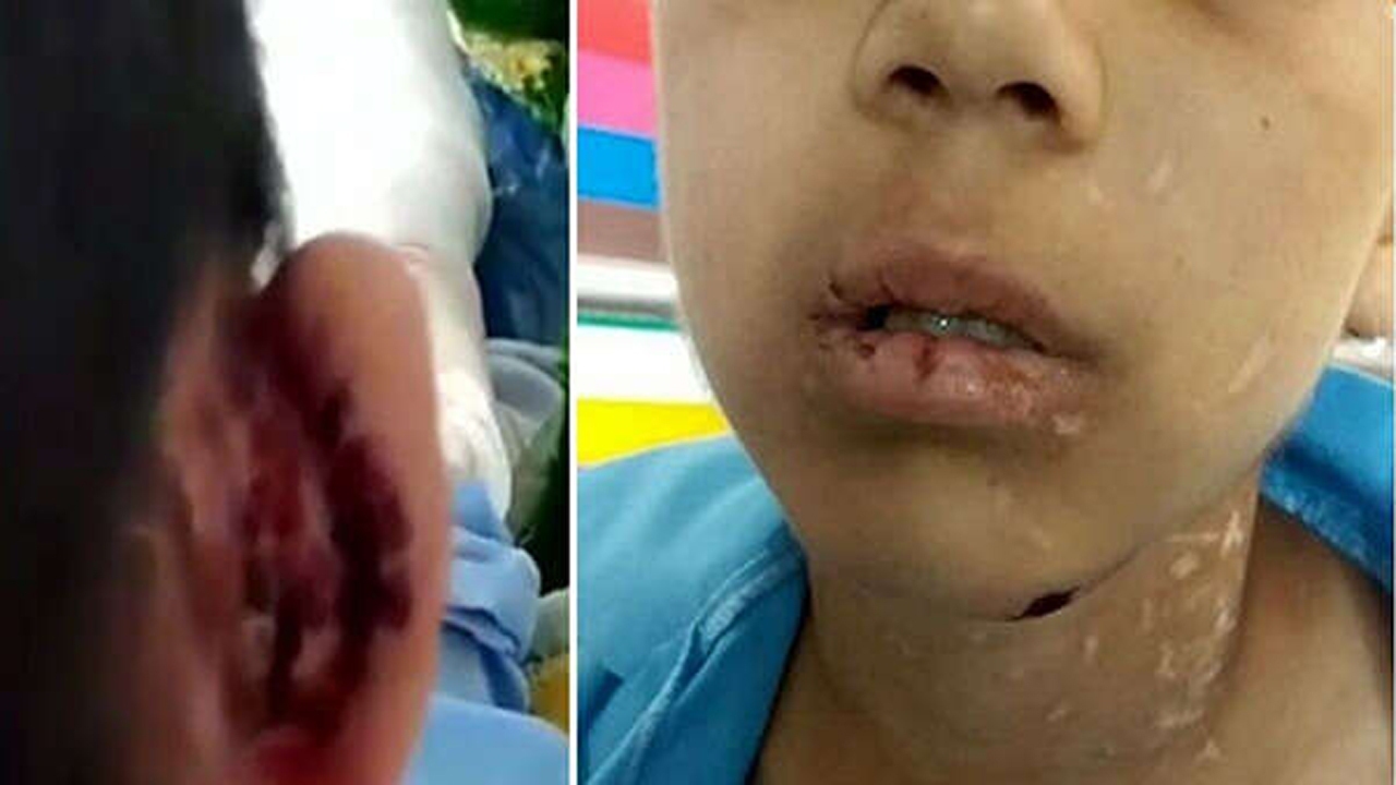 انگشت‌های پای دانیال ۹ ساله بخاطر شکنجه پدر و نامادری قطع شد + عکس