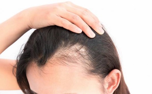 تاثیرات آزار دهنده کرونا بر زیبائی بهبودیافتگان از کرونا