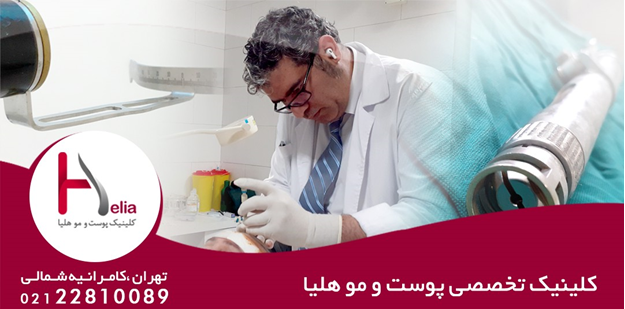 کاشت مو اتوماتیک با جدیدترین متد روز دنیا در کلینیک هلیا