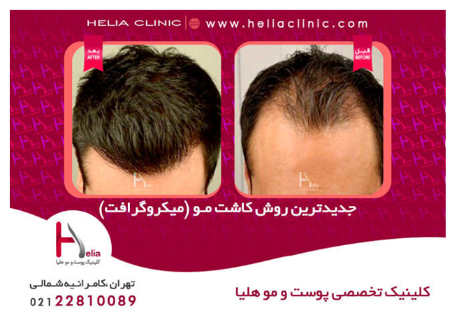 کاشت مو اتوماتیک با جدیدترین متد روز دنیا در کلینیک هلیا