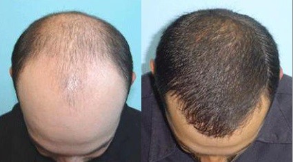 ۱۱ ترکیب خانگی بسیار موثر برای پرپشت&zwnj;شدن مو