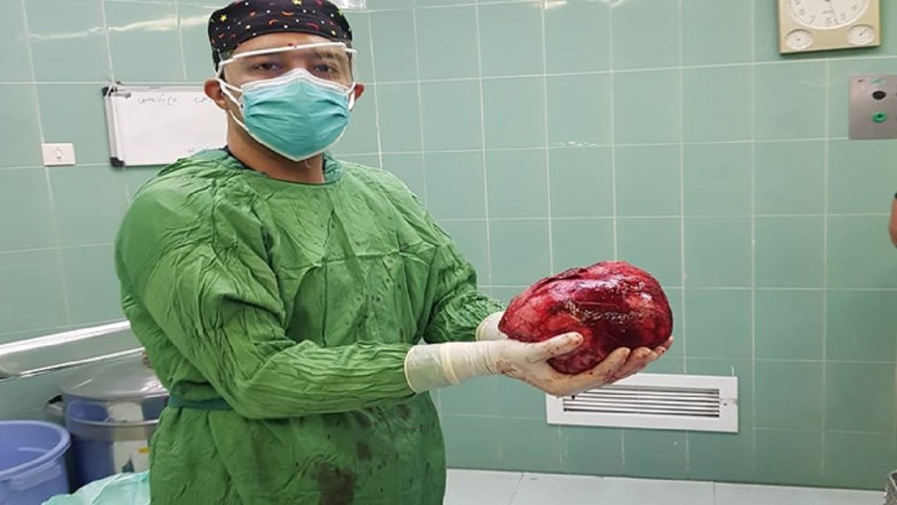 نجات جان دختر ۲۰ ساله با جداسازی توده ۲.۵ کیلوگرمی از قفسه سینه و ریه
