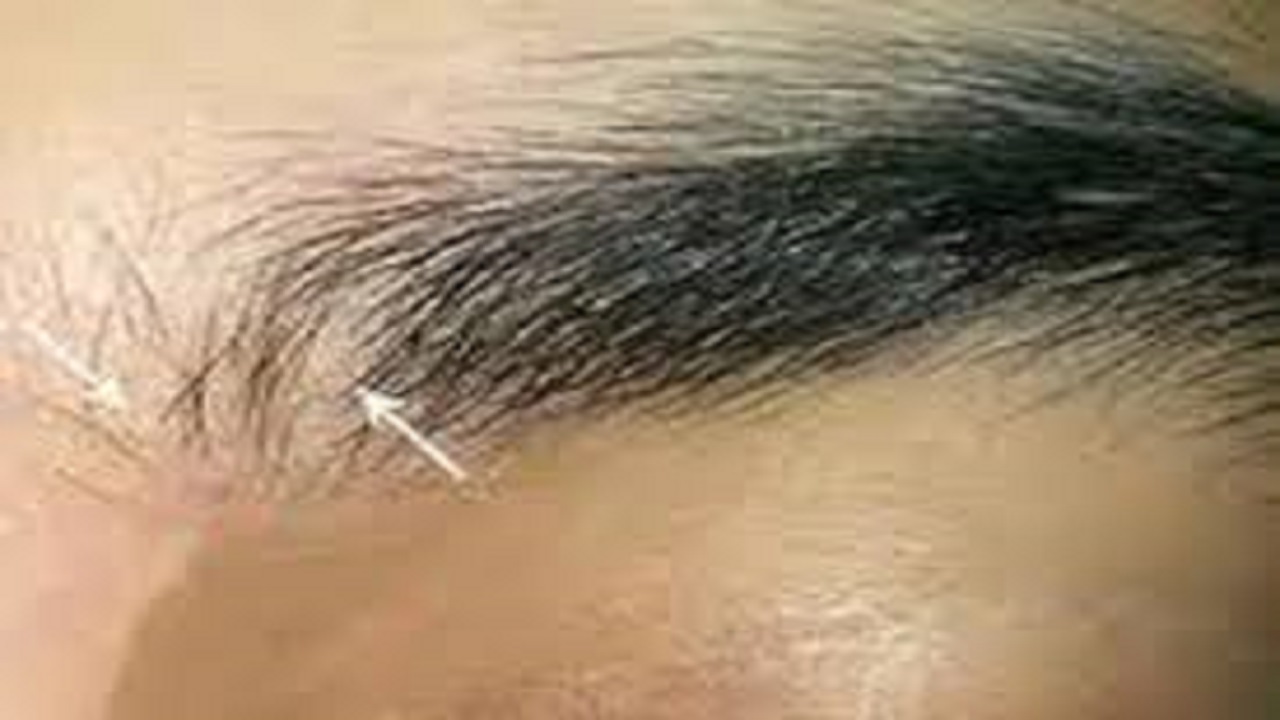 مهم‌ترین عوامل و علت ریزش ابرو در افراد چیست؟