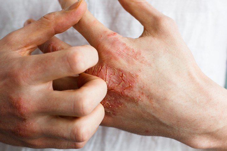 ویروس کرونا؛ بیماری&zwnj;های پوستی اهمیت چندانی ندارند