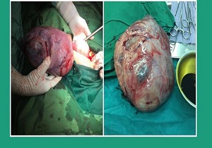 خروج توده ۲۰ سانتی متری از شکم یک زن در قم