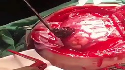 چند نکته مهم برای پیشگیری از سکته مغزی + فیلم