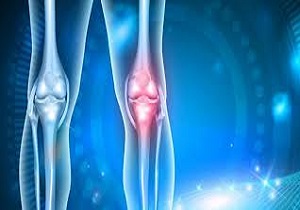 راه های جلوگیری از آرتروز زانو/آرتروز بیماری تخریب تدریجی غضروفِ مفصل
