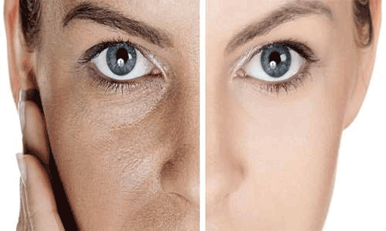 کربوکسی تراپی چیست و چگونه انجام می&zwnj;شود؟