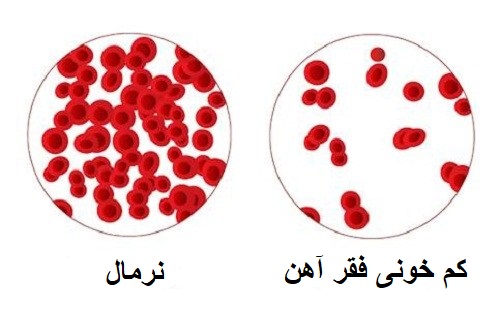 علت و علائم کم خونی فقر آهن چیست و چگونه درمان می&zwnj;شود؟
