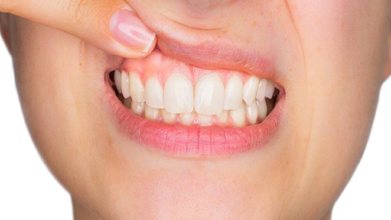 علت بروز جوش لثه و راه‌های درمان آن چیست؟