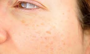 برای لکه&zwnj;های تیره پوست چه کنیم؟