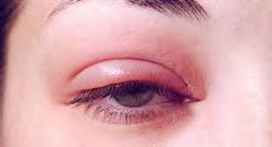 عفونت حاد چشم ها/ آیا نگران گل مژه باشیم؟ / آیاگل مژه برای چشم افراد فایده دارد؟ / دلیل اصلی بروز گل مژه و روش&zwnj;های درمانی آن